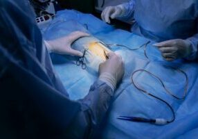 Doctors getting read to perform a Exploratory Laparotomy